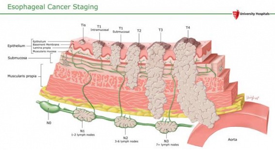 Cancer of the Esophagus
