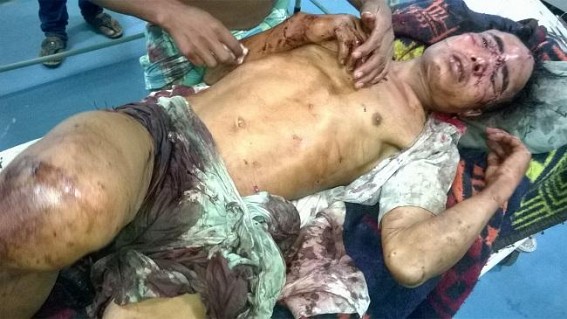 Santirbazar : Wild Bear critically mauls villager; battling for life in Gomati Dist Hospital
