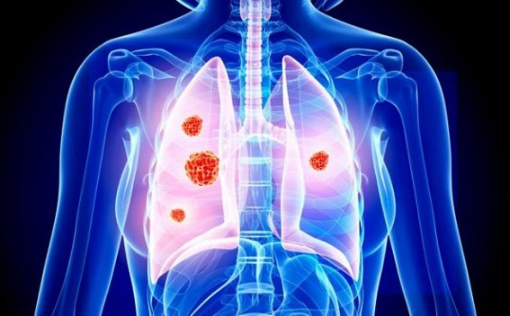 Northeastern states experience higher burden of cancers: ICMR