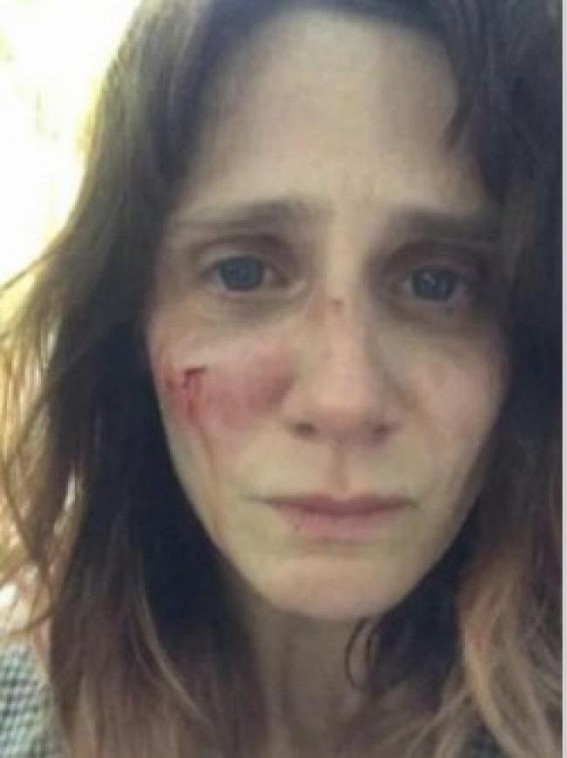 Victim of domestic abuse, French actress posts shocking pics on Instagram