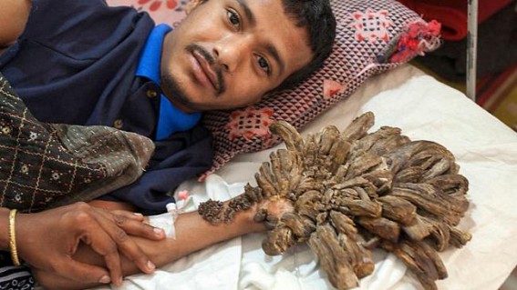 Bangladesh's 'tree man' back in hospital