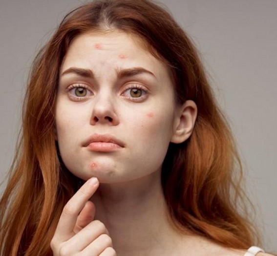 Poor dietary habits, increased stress linked with acne