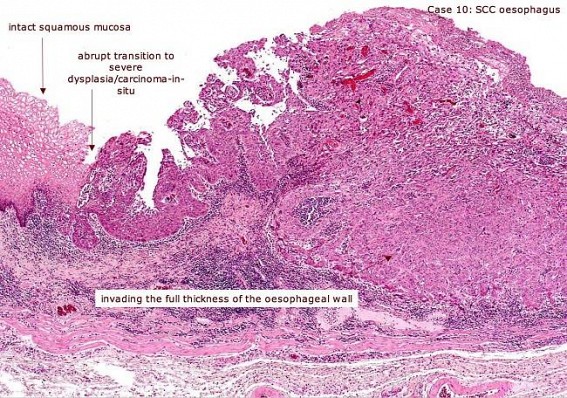 The story of  the Carcinoma of the Oesophagus: the misadventures